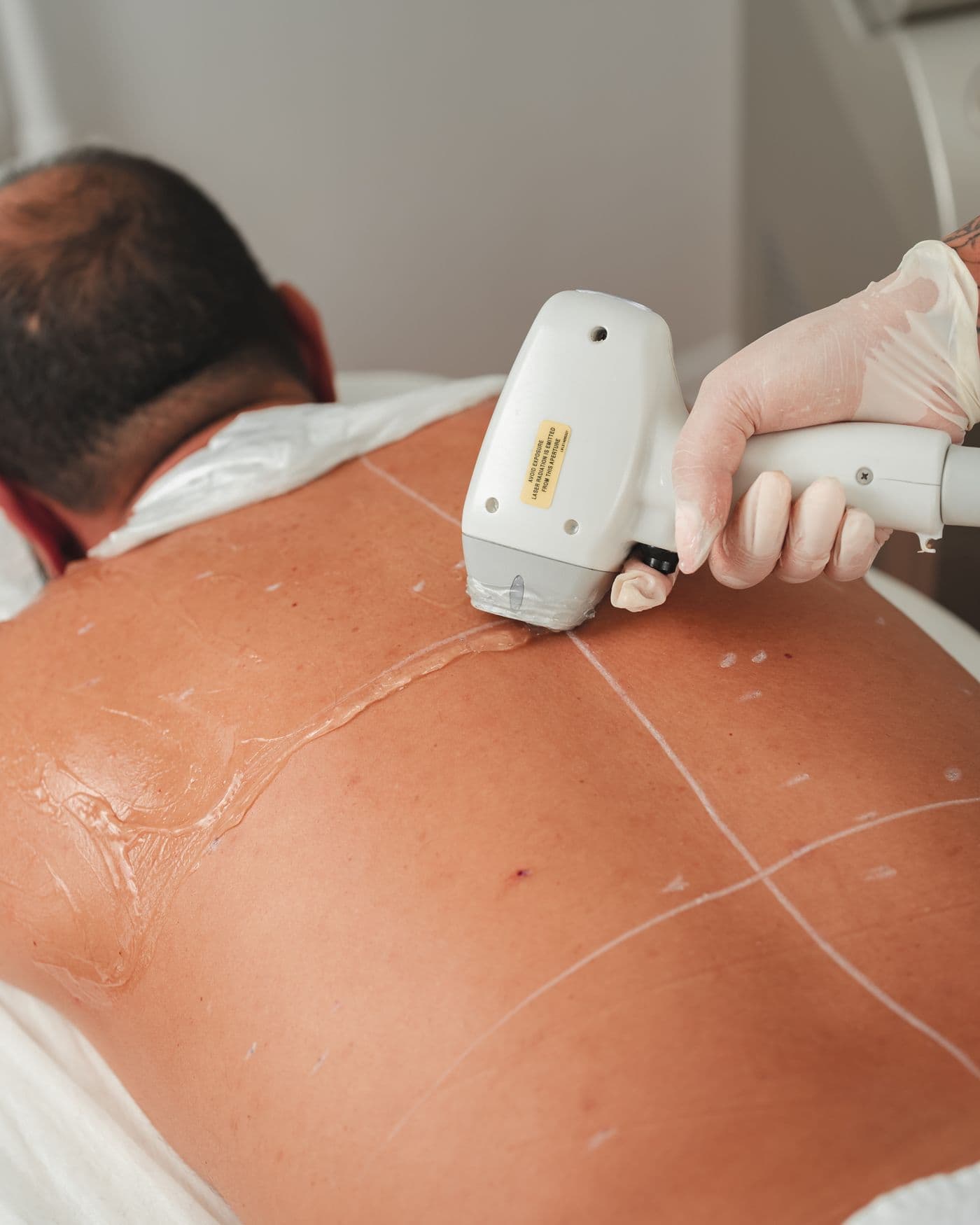 Tretman laserske epilacije leđa u salonu Titan No.1